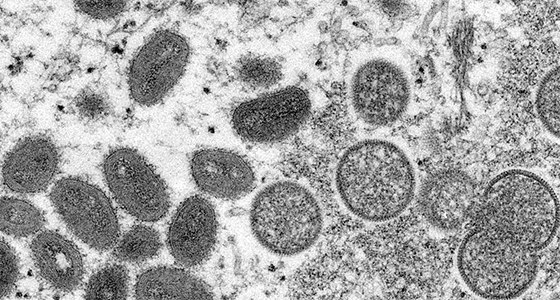 Electron micrograph of monkeypox virus particles isolated in 2003 in the United States from human samples (left, mature, oval viruses; right, immature, round viruses). Cynthia S. Goldsmith, Russell Regner / CDC / AP